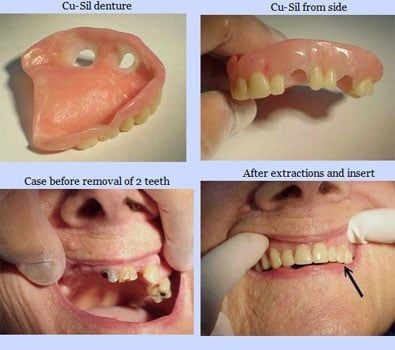 Aspen Dental Dentures Dickens IA 51333